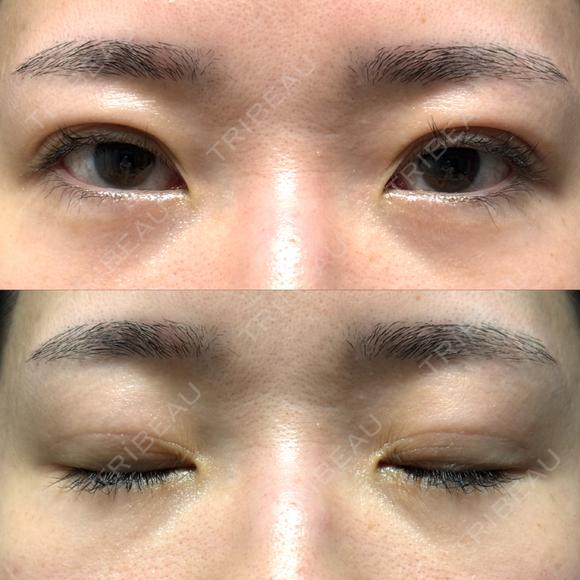 二重埋没 / クマ治療 / 上まぶたの脂肪取り / 下まぶたの脂肪取り NARU Beauty Clinic 【ナルクリ】 DAY 32 メイン用