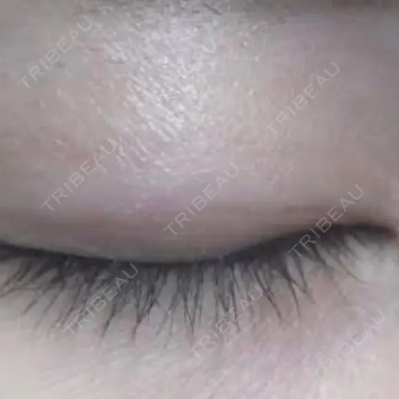 ほくろ・いぼ切除（肌） ガーデンクリニック 船橋院 AFTER メイン用