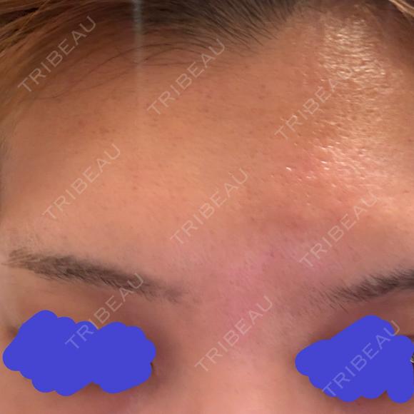 ポテンツァ NARU Beauty Clinic 【ナルクリ】 DAY 1 メイン用