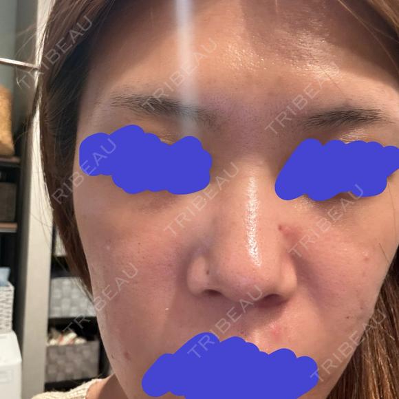 ポテンツァ NARU Beauty Clinic 【ナルクリ】 AFTER メイン用