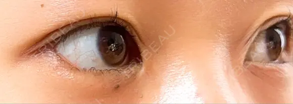 目尻切開 / タレ目形成・グラマラスライン（埋没） A CLINIC（エークリニック） 新宿院 DAY 14 メイン用