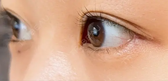 目尻切開 / タレ目形成・グラマラスライン（埋没） A CLINIC（エークリニック） 新宿院 DAY 14 メイン用