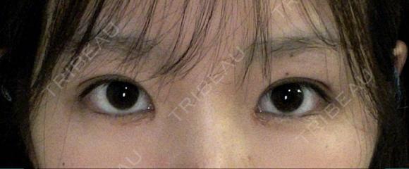 目頭切開 / 自然癒着法 / 眼瞼下垂（非切開） LUHO（ルホ）美容外科 DAY 31 メイン用