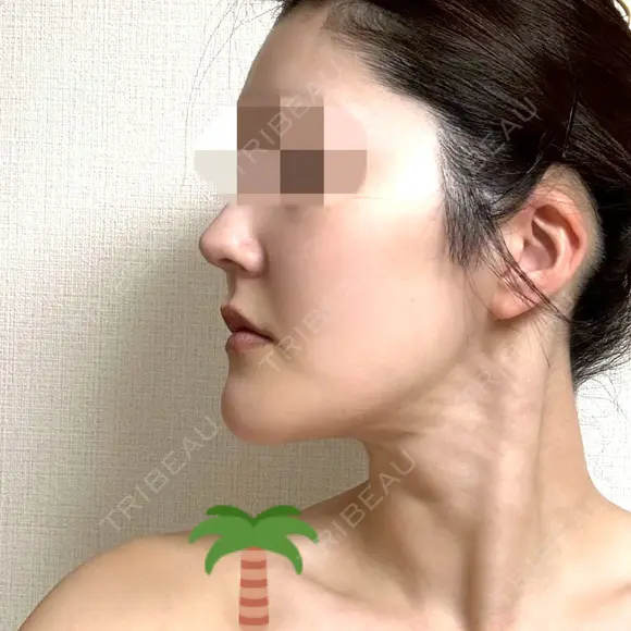 脂肪吸引（顔） 銀座マイアミ美容外科 DAY 217 メイン用