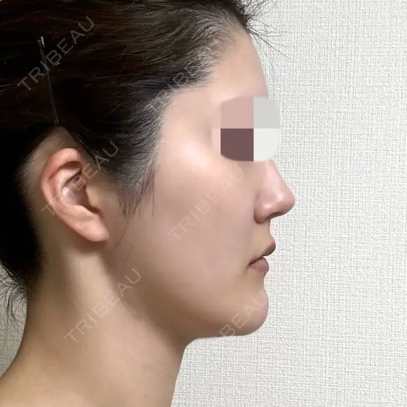 脂肪吸引（顔） 銀座マイアミ美容外科 DAY 217 メイン用