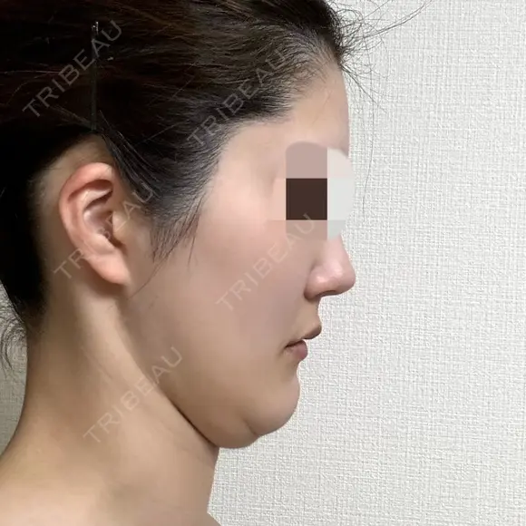 脂肪吸引（顔） 銀座マイアミ美容外科 DAY 217 メイン用