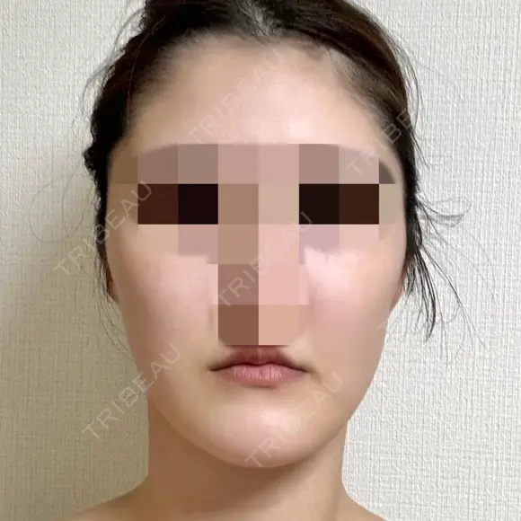 脂肪吸引（顔） 銀座マイアミ美容外科 AFTER メイン用