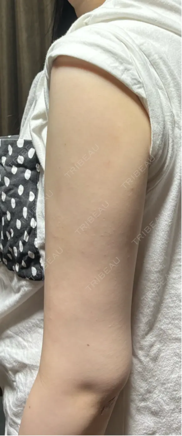 脂肪吸引（二の腕） / 脂肪吸引（肩） 湘南美容クリニック 高崎院 DAY 60 メイン用