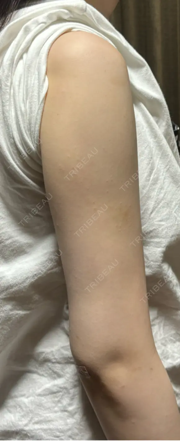 脂肪吸引（二の腕） / 脂肪吸引（肩） 湘南美容クリニック 高崎院 DAY 60 メイン用