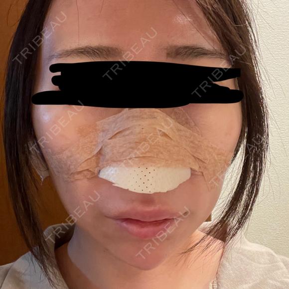 鼻尖形成（切開） / 軟骨移植 / 鼻柱下降・鼻唇角形成（猫手術） eクリニック 金沢本院 DAY 1 メイン用