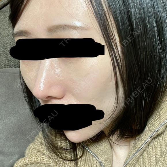 鼻尖形成（切開） / 軟骨移植 / 鼻柱下降・鼻唇角形成（猫手術） eクリニック 金沢本院 DAY 32 メイン用