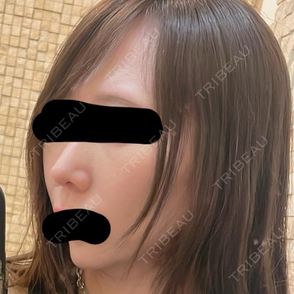 鼻尖形成（切開） / 軟骨移植 / 鼻柱下降・鼻唇角形成（猫手術） eクリニック 金沢本院 AFTER メイン用