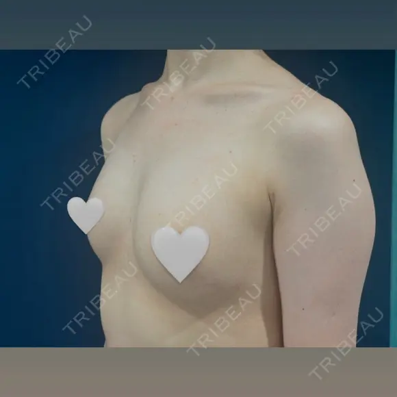 豊胸（脂肪注入） S.T styleクリニック DAY 107 メイン用