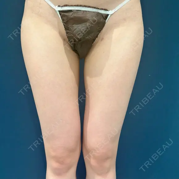 豊胸（脂肪注入） S.T styleクリニック DAY 107 メイン用