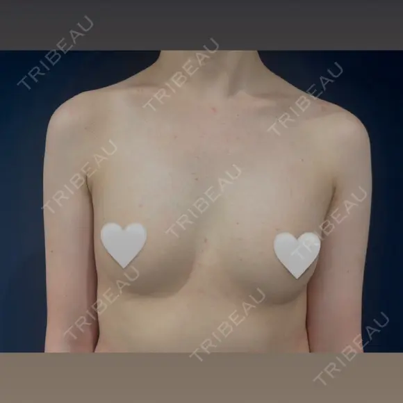 豊胸（脂肪注入） S.T styleクリニック AFTER メイン用