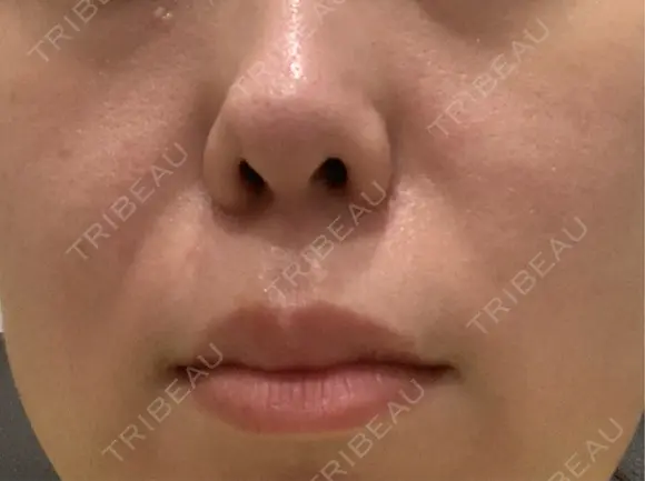 その他（肌） ゆきスキンクリニック 東池袋 DAY 34 メイン用