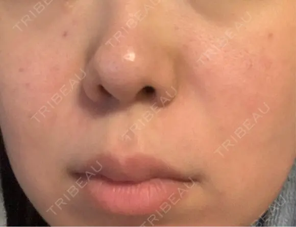 その他（肌） ゆきスキンクリニック 東池袋 DAY 36 メイン用