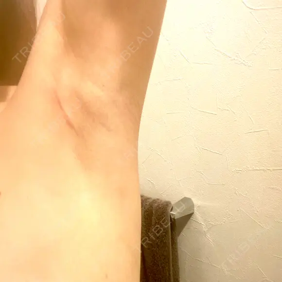 豊胸（シリコン＋脂肪併用） MYCLI【マイクリ】東京・恵比寿院 DAY 97 メイン用