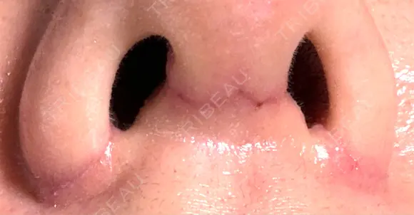 小鼻縮小（切開） / 鼻尖縮小 / 鼻柱下降・鼻唇角形成（猫手術） 東京シンデレラ美容外科 池袋院 DAY 8 メイン用