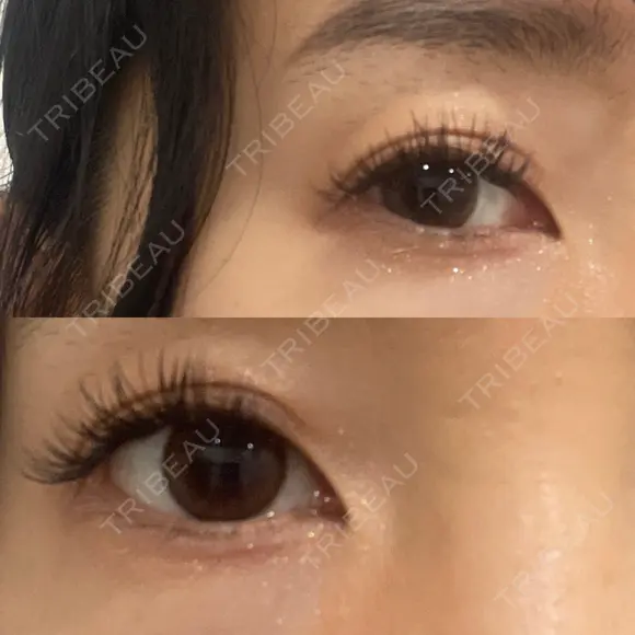 二重埋没 / ヒアルロン酸注入（目の下） BELINDA CLINIC（ベリンダクリニック）岡山院 AFTER メイン用