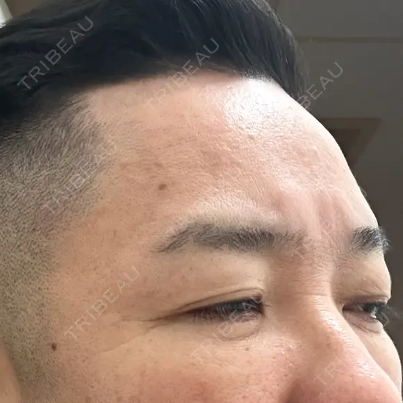 下まぶたたるみ取り / 下まぶたの脂肪取り / 脂肪注入（目の下） 湘南美容クリニック 千葉センシティ院 DAY 8 メイン用