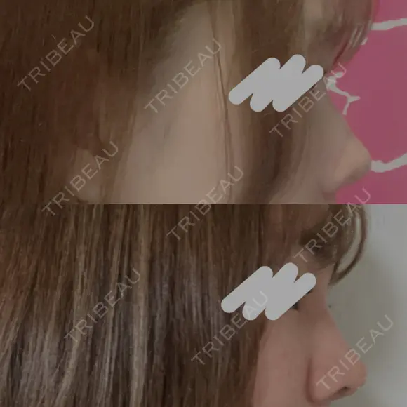 スレッドノーズ / 鼻中隔延長（非切開） ASTRA BEAUTY CLINIC DAY 2 メイン用