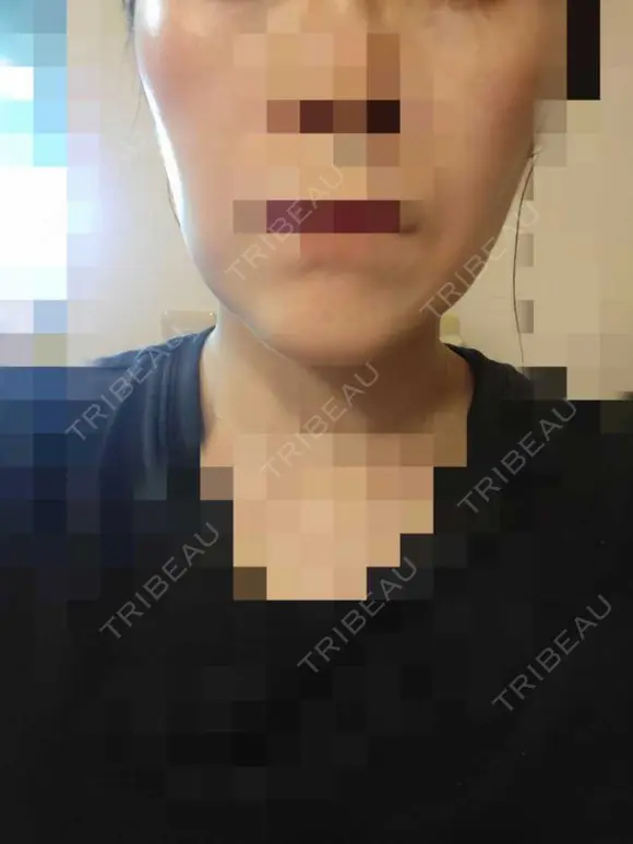 ボトックス（エラ・小顔） PRISM Beauty Clinic 町田院 DAY 14 メイン用