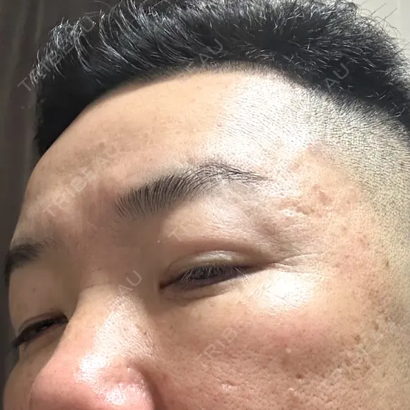 下まぶたたるみ取り / 下まぶたの脂肪取り / 脂肪注入（目の下） 湘南美容クリニック 千葉センシティ院 DAY 9 メイン用