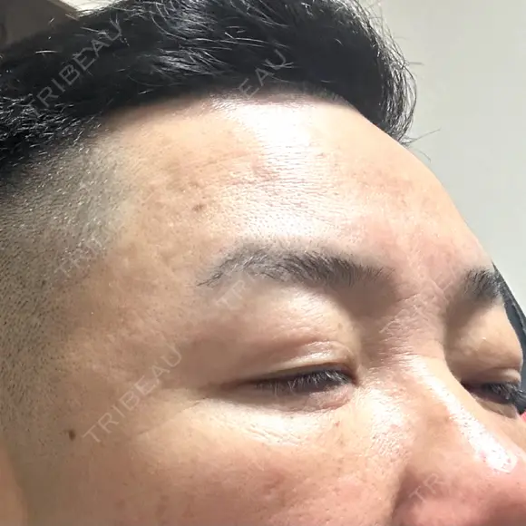 下まぶたたるみ取り / 下まぶたの脂肪取り / 脂肪注入（目の下） 湘南美容クリニック 千葉センシティ院 DAY 9 メイン用