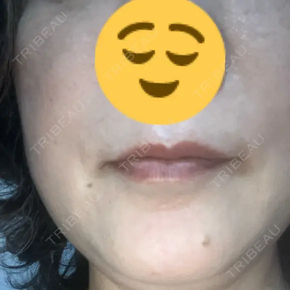 医療脱毛（顔） 美容皮膚科エルムクリニック 大阪院 AFTER メイン用
