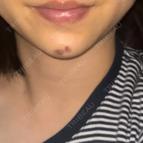 ヒアルロン酸注入（あご） ヴェリテクリニック 大阪院 DAY 3 メイン用