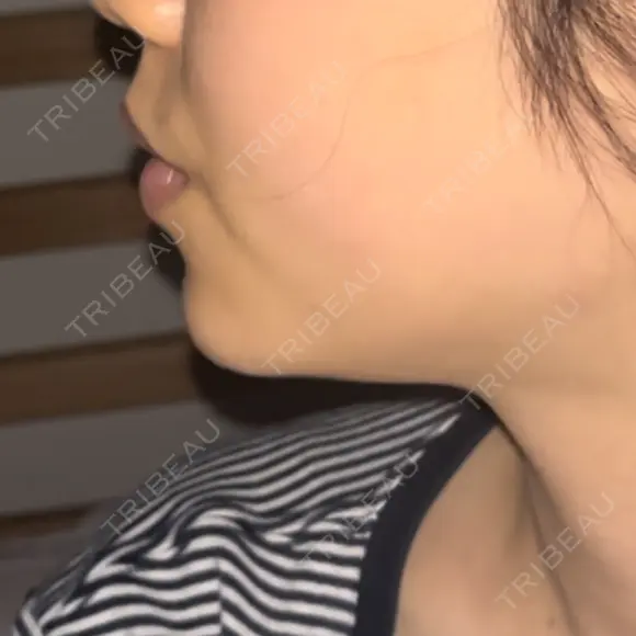 ヒアルロン酸注入（あご） ヴェリテクリニック 大阪院 DAY 3 メイン用