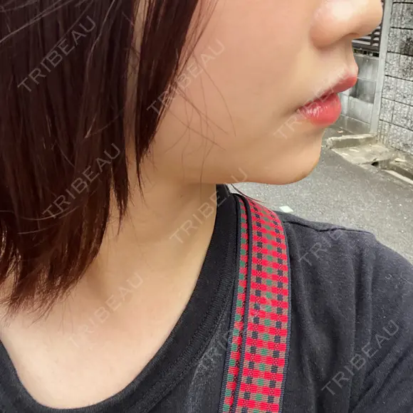 ヒアルロン酸注入（あご） ヴェリテクリニック 大阪院 DAY 2 メイン用