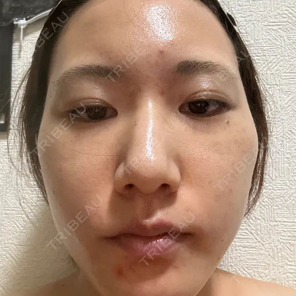 ボトックス（エラ・小顔） TCB東京中央美容外科 川口院 DAY 4 メイン用