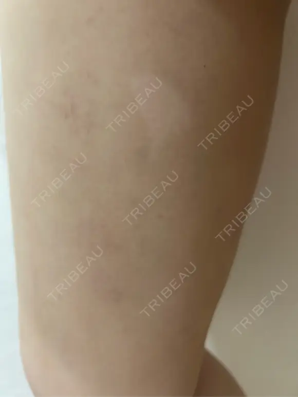 脂肪吸引（脚） / ボトックス（ふくらはぎ） THE CLINIC（ザ・クリニック） 福岡院 DAY 14 メイン用