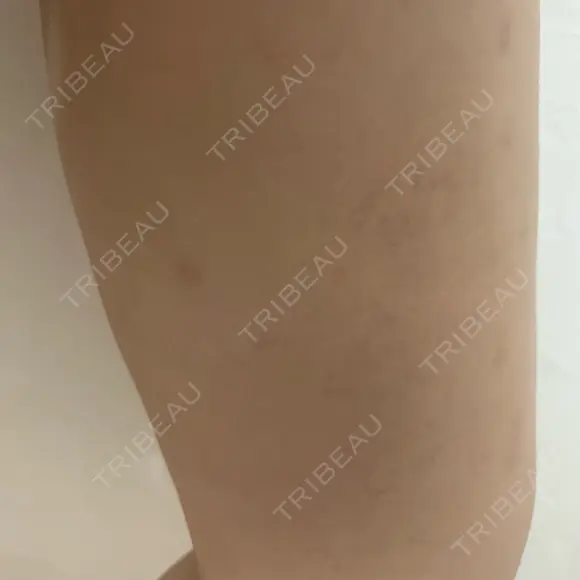 脂肪吸引（脚） / ボトックス（ふくらはぎ） THE CLINIC（ザ・クリニック） 福岡院 DAY 14 メイン用