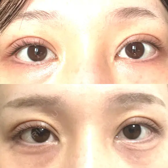 二重埋没 BELINDA CLINIC（ベリンダクリニック）新宿院 DAY 34 メイン用