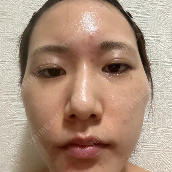 ボトックス（エラ・小顔） TCB東京中央美容外科 川口院 AFTER メイン用