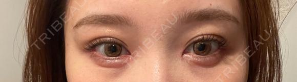 目頭切開 / 目尻切開 / 自然癒着法 / ヒアルロン酸注入（涙袋） LUHO（ルホ）美容外科 DAY 28 メイン用