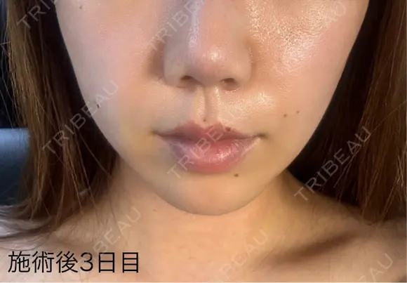 ヒアルロン酸注入（頬） / その他（口元） アリエル美容クリニック 郡山院 DAY 0 メイン用