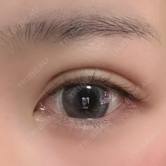 二重埋没 / ヒアルロン酸注入（涙袋） LOCHIC CLINIC GINZA【ロシッククリニック銀座】 DAY 18 メイン用