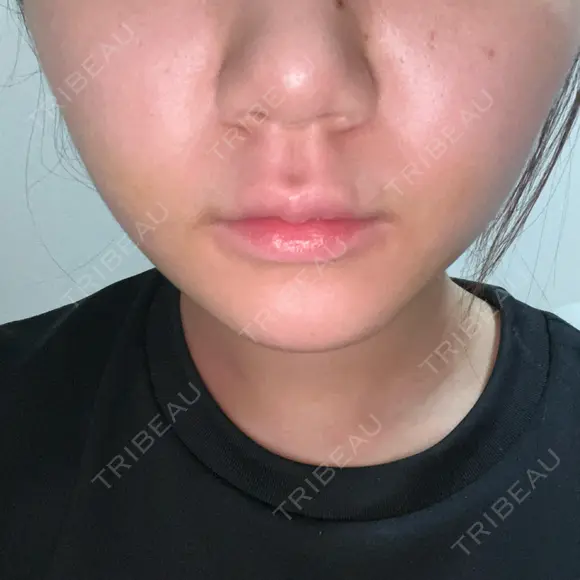 糸リフト / 脂肪吸引（顔） / ボトックス（エラ・小顔） ルラ美容クリニック 広島院 DAY 3 メイン用