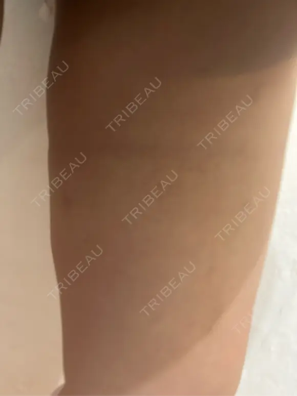 脂肪吸引（脚） / ボトックス（ふくらはぎ） THE CLINIC（ザ・クリニック） 福岡院 DAY 15 メイン用