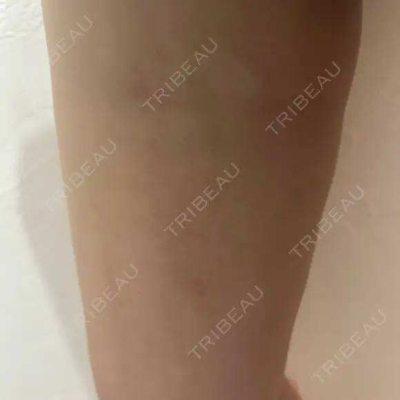 脂肪吸引（脚） / ボトックス（ふくらはぎ） THE CLINIC（ザ・クリニック） 福岡院 DAY 15 メイン用