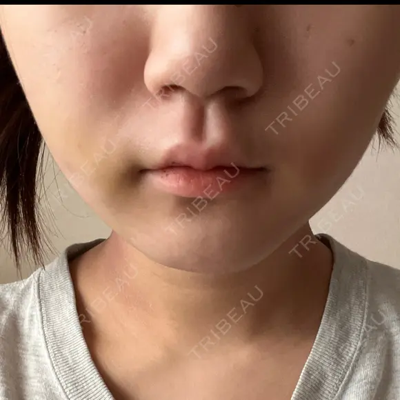 糸リフト / 脂肪吸引（顔） / ボトックス（エラ・小顔） ルラ美容クリニック 広島院 DAY 3 メイン用