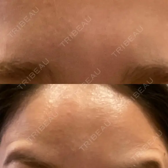 ボトックス（眉間） / ボトックス（額） / その他（鼻） ROOTS Clinic AFTER メイン用