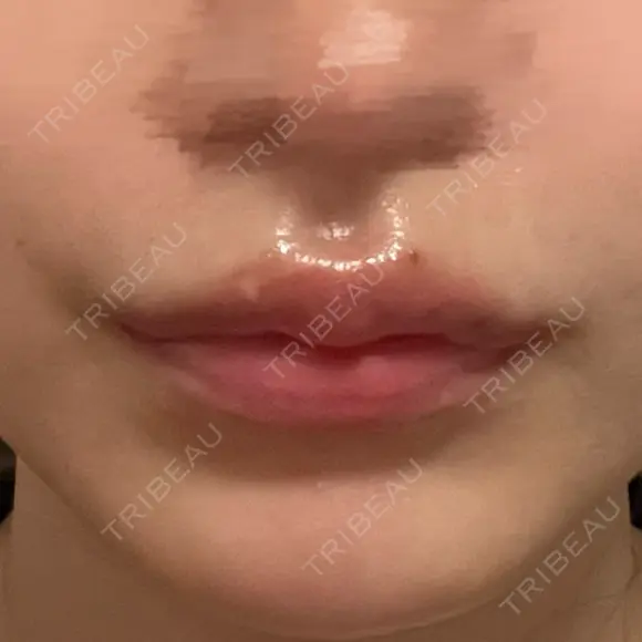 ヒアルロン酸注入（涙袋） / ヒアルロン酸注入（唇） フィラークリニック 渋谷院 AFTER メイン用