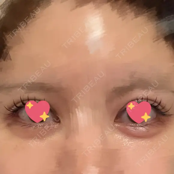 ヒアルロン酸注入（涙袋） / ヒアルロン酸注入（唇） フィラークリニック 渋谷院 DAY 3 メイン用