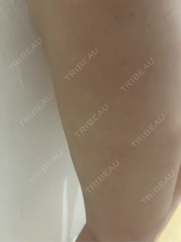 脂肪吸引（脚） / ボトックス（ふくらはぎ） THE CLINIC（ザ・クリニック） 福岡院 DAY 16 メイン用