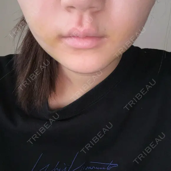 糸リフト / 脂肪吸引（顔） / ボトックス（エラ・小顔） ルラ美容クリニック 広島院 DAY 4 メイン用